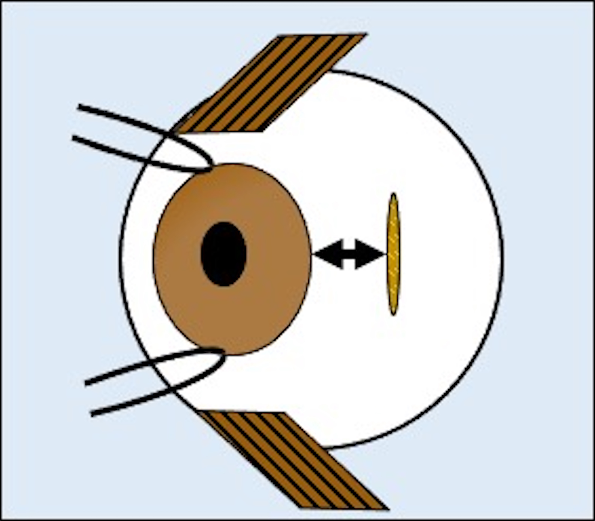 Medial rectus insertion site in cases of acute acquired comitant esotropia associated with excessive digital device usage