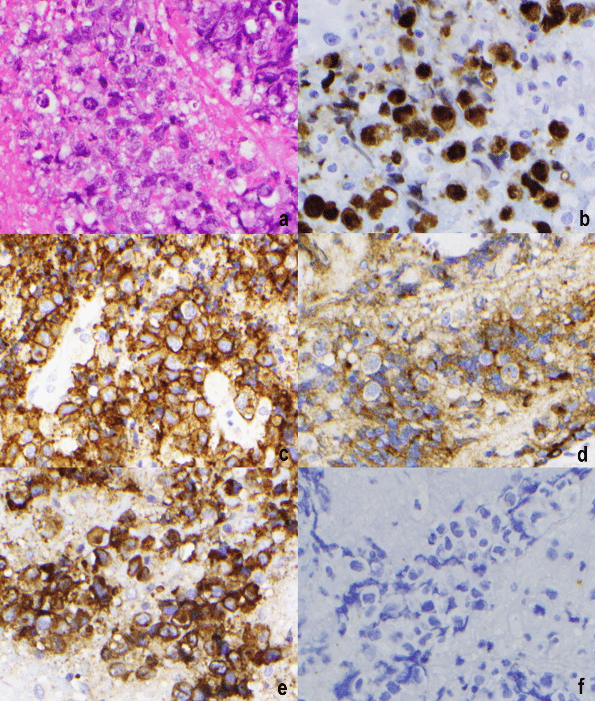 Clinicopathologic features of primary central nervous system anaplastic large cell lymphoma: a multicenter study identifies age and ALK status as prognostic factors