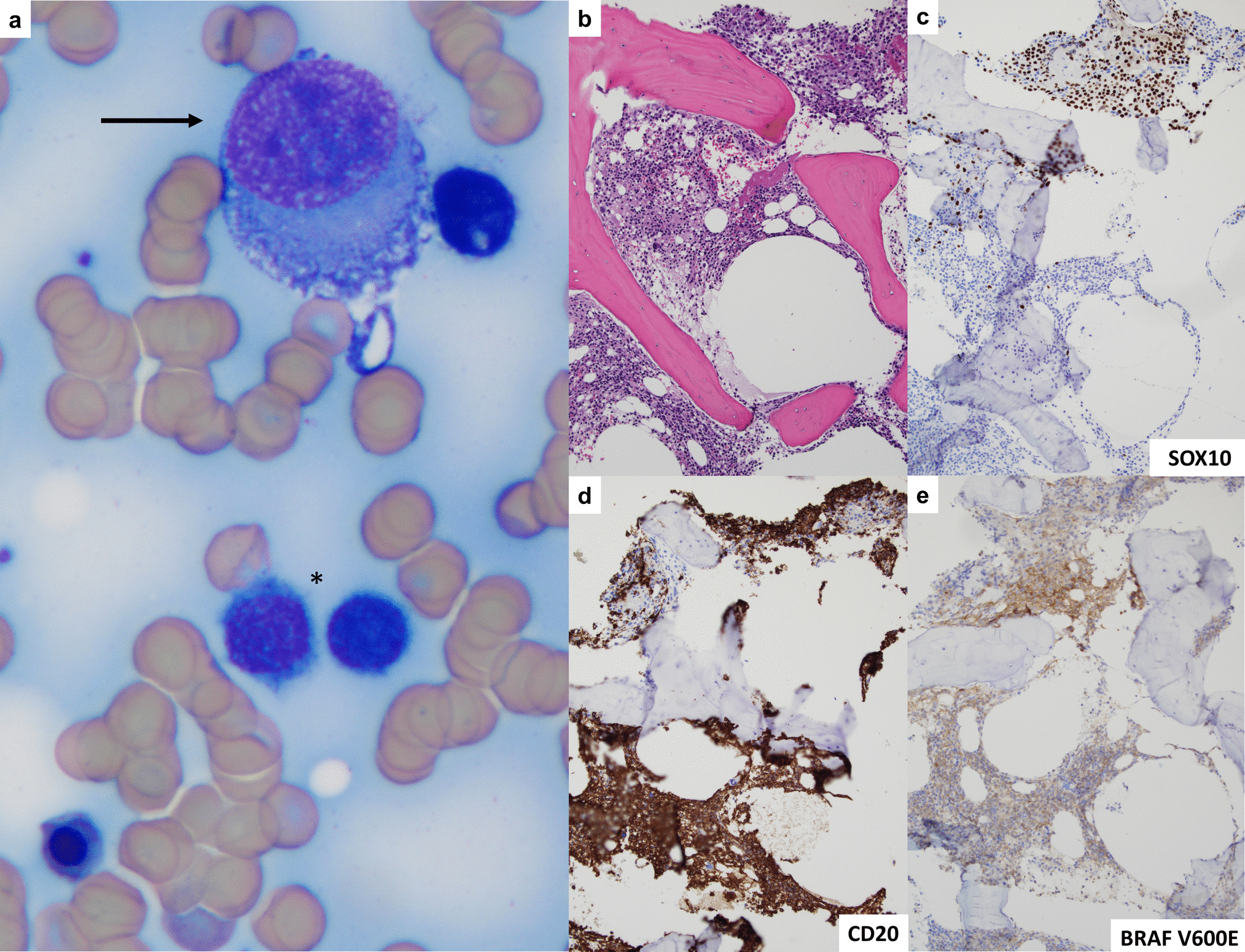 Concurrent involvement of the bone marrow by BRAF V600E–mutant melanoma and hairy cell leukemia