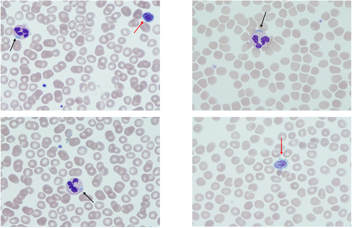 Macrothrombocytopenia and granulopoieitic Döhle body-like inclusions in a MYH9-related disorder