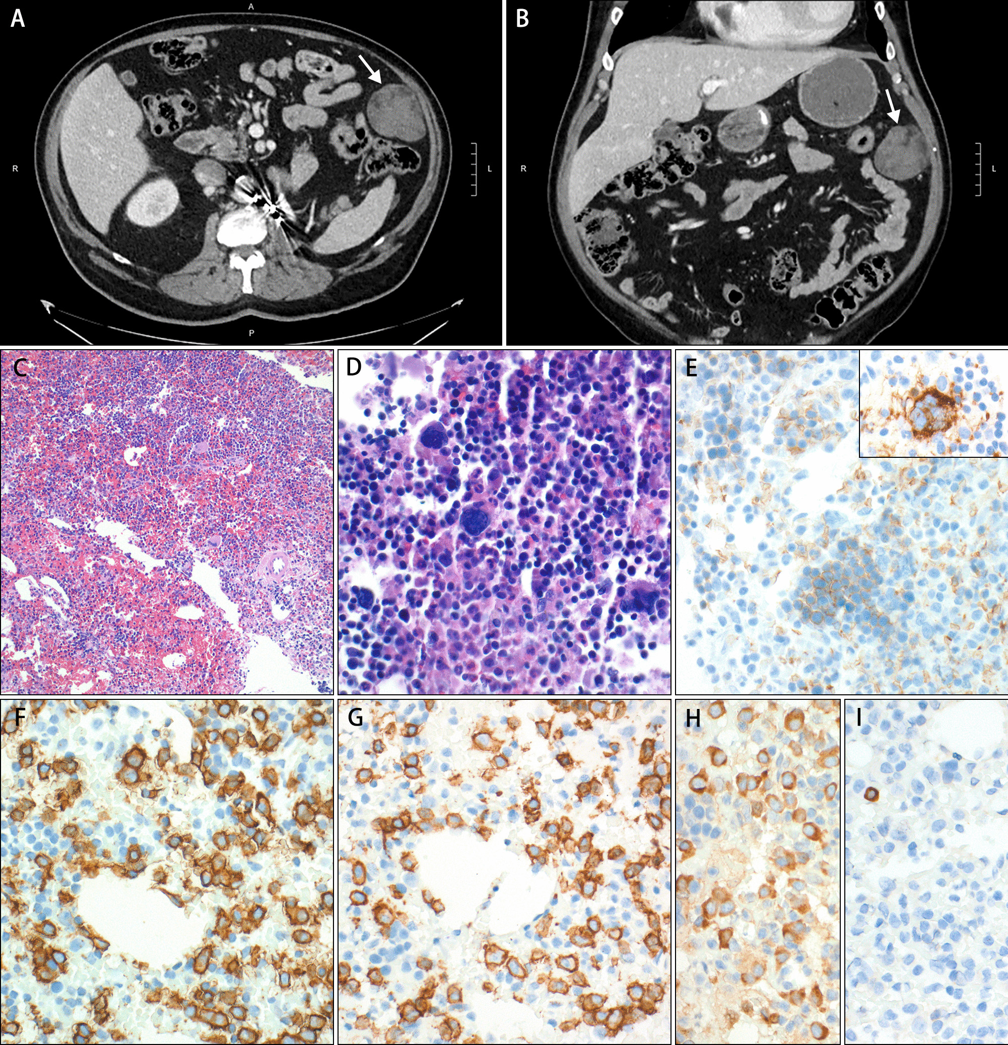 Extra-adrenal myelolipoma involved by plasma cell neoplasm: homing of neoplastic plasma cells to a site of ectopic hematopoiesis