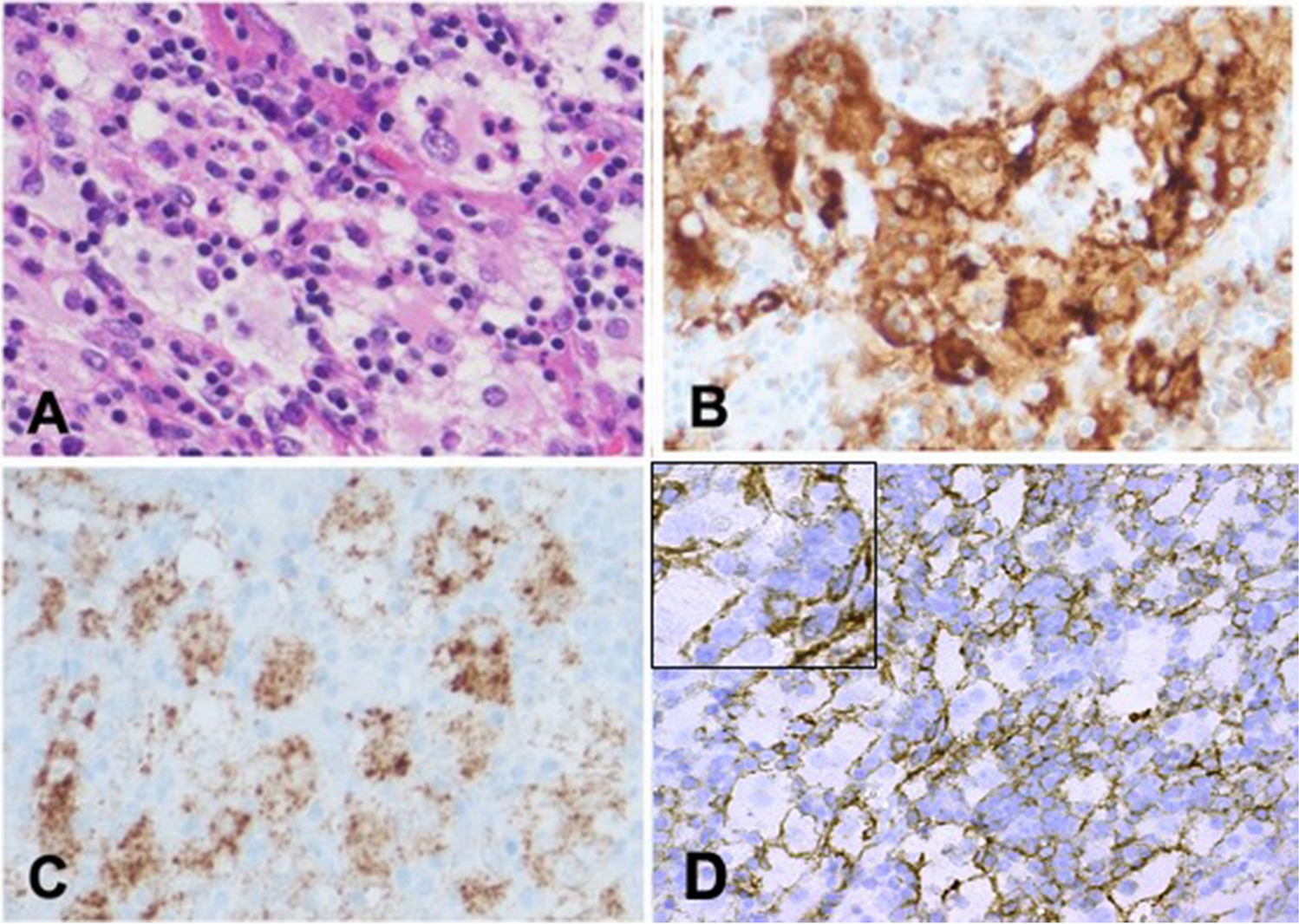 BRAF V600E mutation and high expression of PD-L1 in Rosai-Dorfman disease: case report and review of the literature