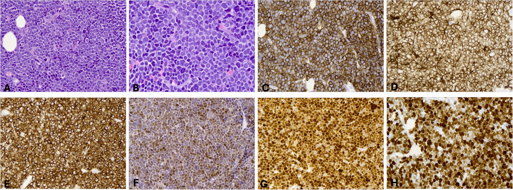 Complete loss of lineage defining antigens in two cases of B-cell malignancies following CAR-T therapy