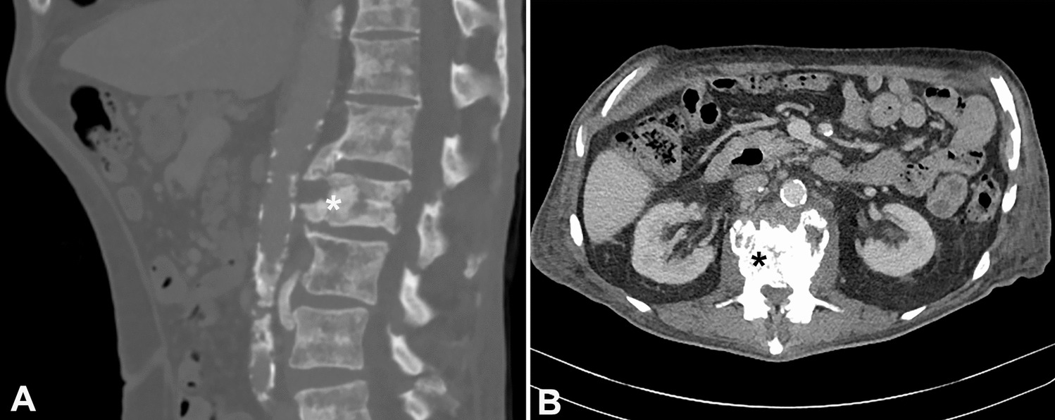 Mast cell sarcoma with KIT p.D816V mutation and concurrent systemic mastocytosis