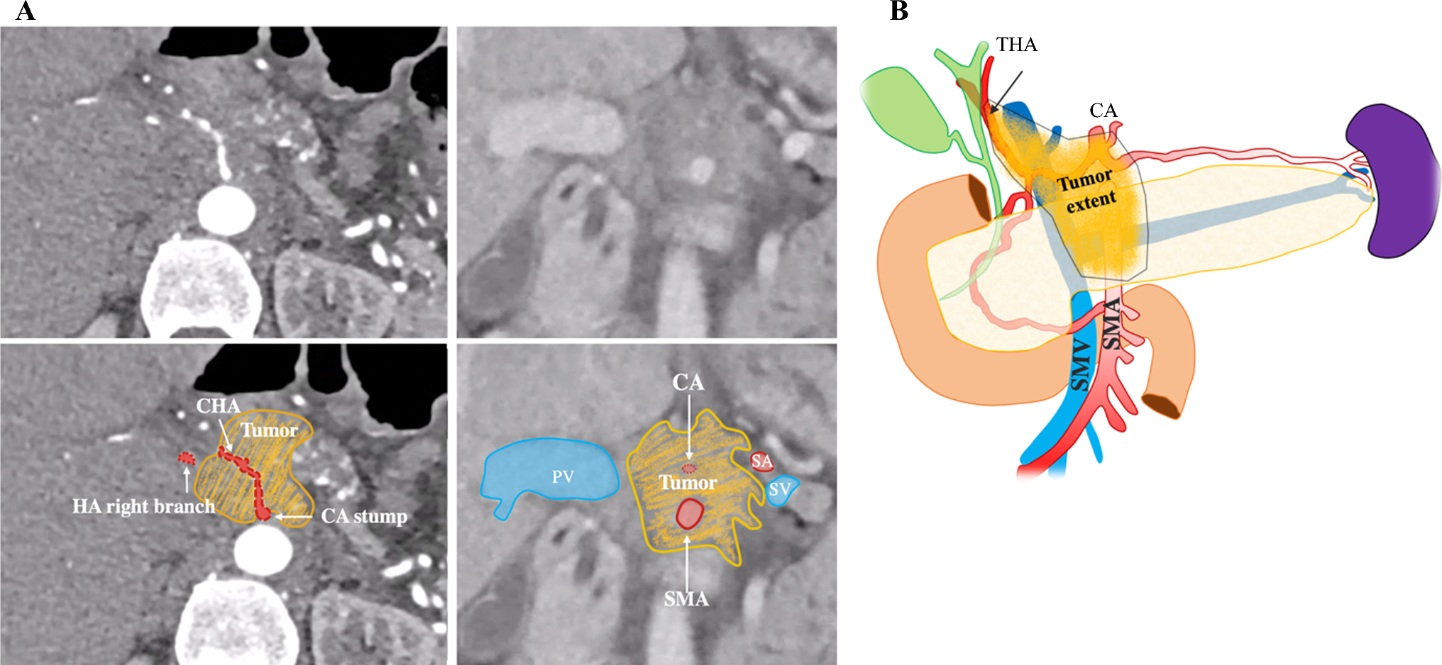 Two-Stage Mayo Clinic Class IIIb Celiac Axis Resection for Pancreatic Adenocarcinoma: Stepwise Management