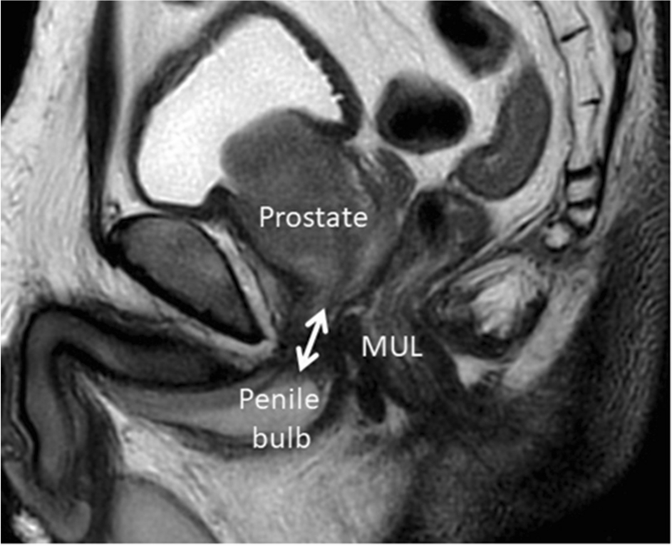 Holmium laser enucleation of the prostate: Modified urethral mucosa pre-dissected technique versus traditional three-lobe technique-A retrospective study