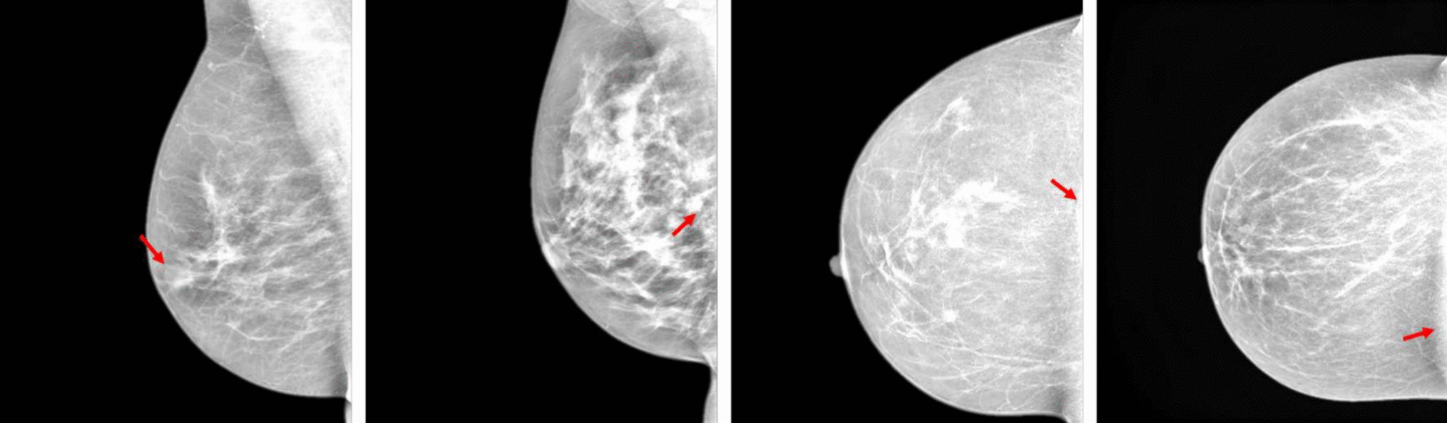 Towards Automated Semantic Segmentation in Mammography Images for Enhanced Clinical Applications
