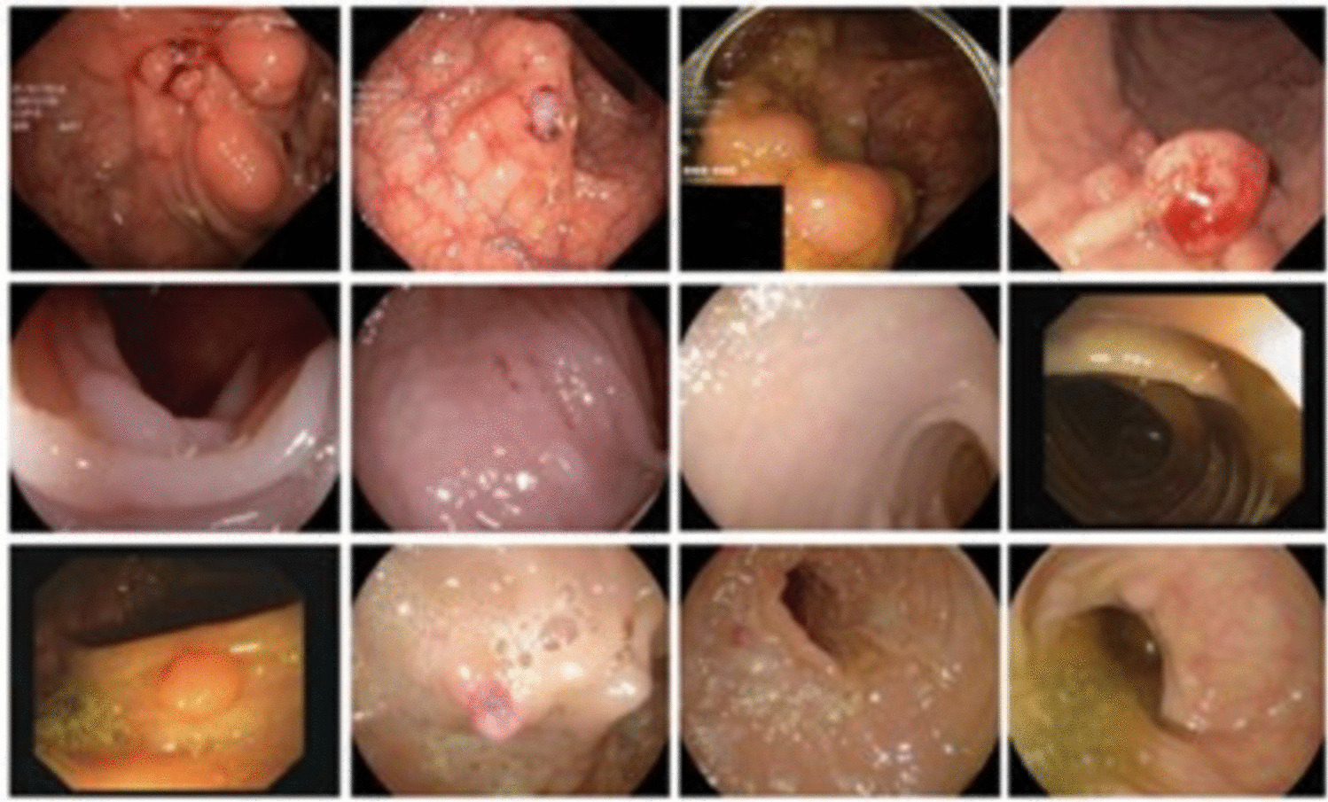 ColonNeXt: Fully Convolutional Attention for Polyp Segmentation