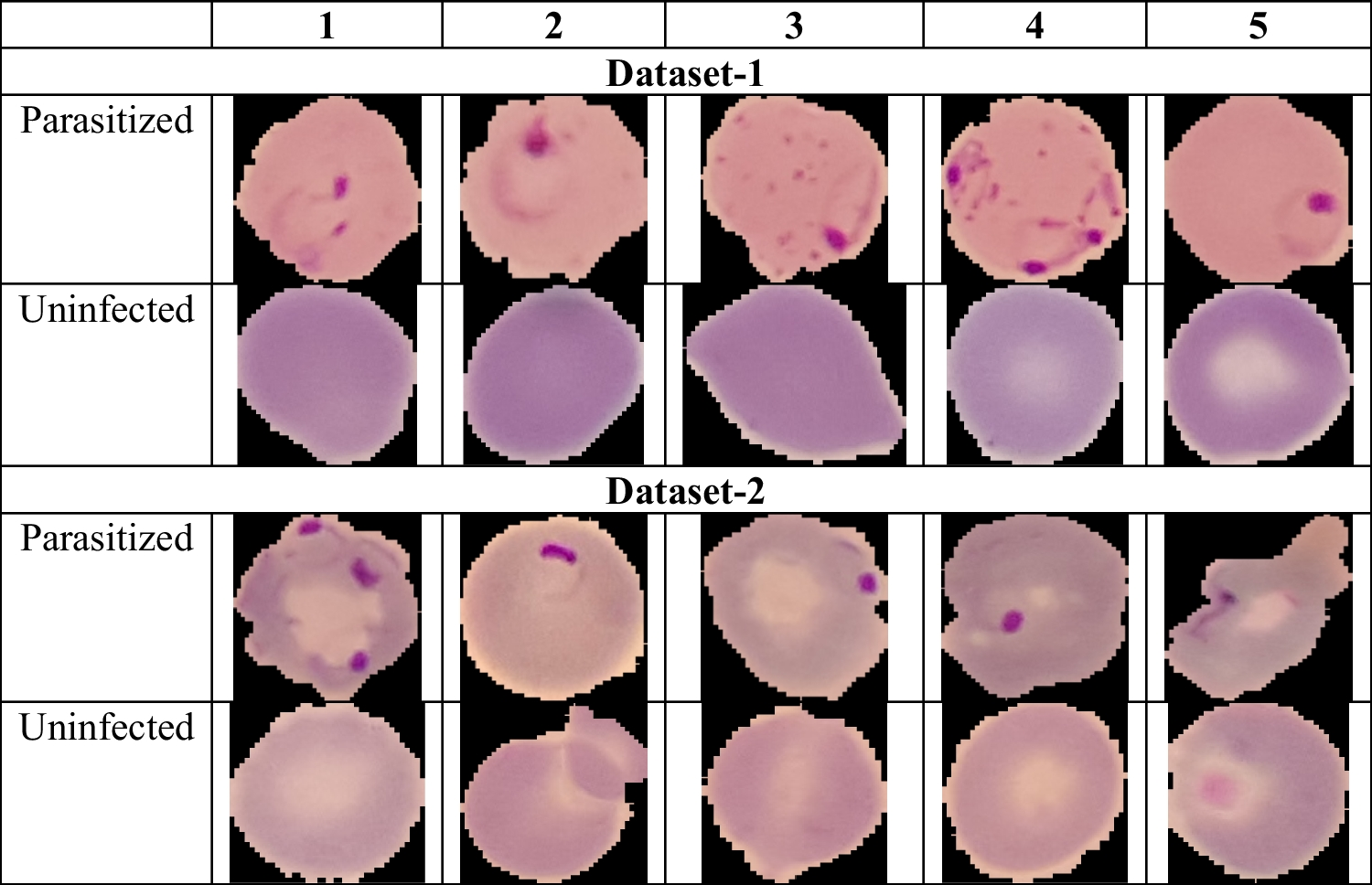 A Robust Malaria Cell Detection Framework Using Adaptive and Atrous Convolution-Based Recurrent Mobilenetv2 with Trans-MobileUNet + + -Based Abnormality Segmentation