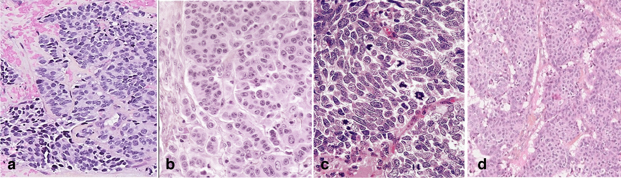 Diagnostic relevance of p53 and Rb status in neuroendocrine tumors G3 from different organs: an immunohistochemical study of 465 high-grade neuroendocrine neoplasms