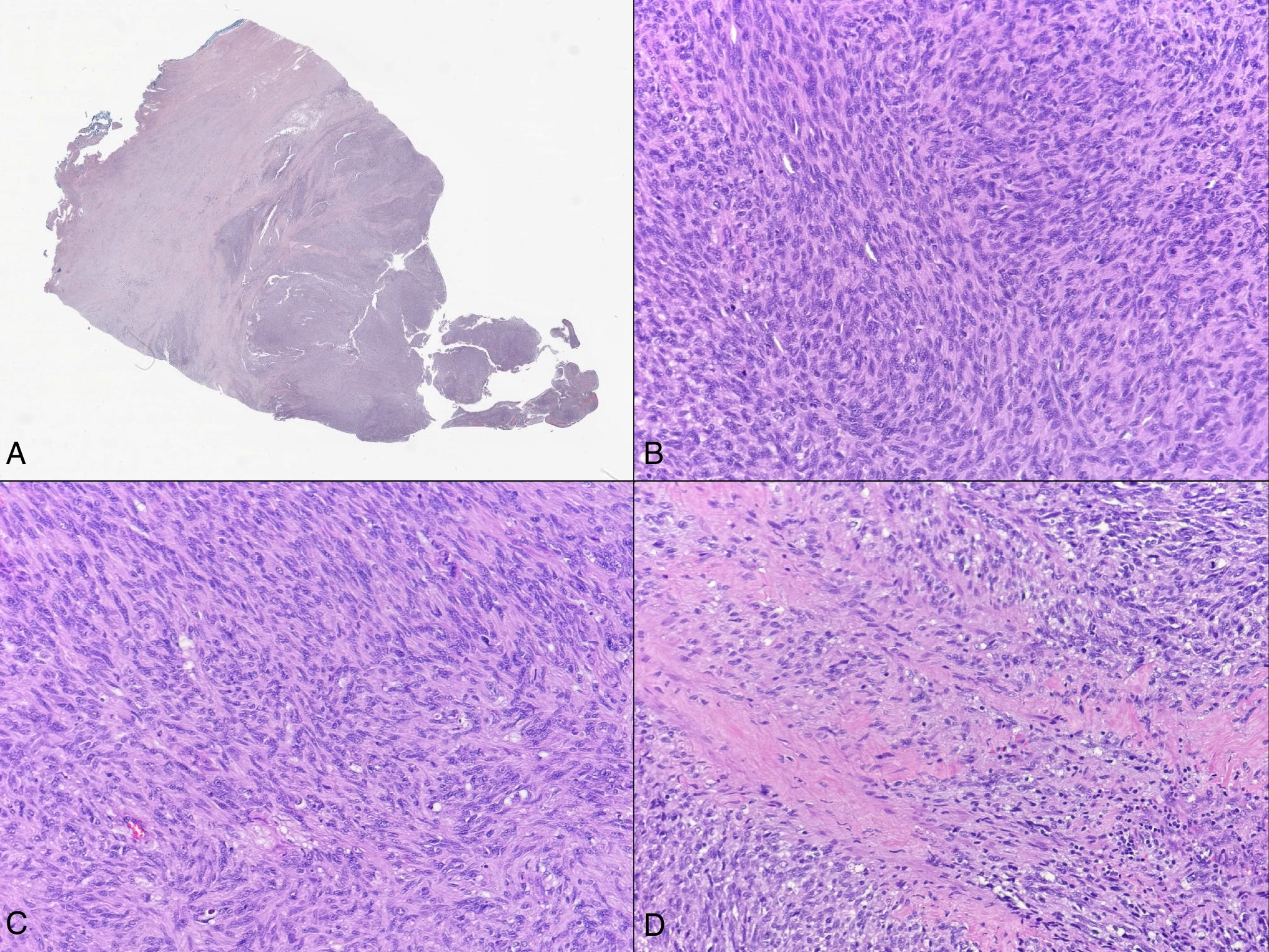 ERBB2/ERBB3-mutated S100/SOX10-positive uterine sarcoma: something new