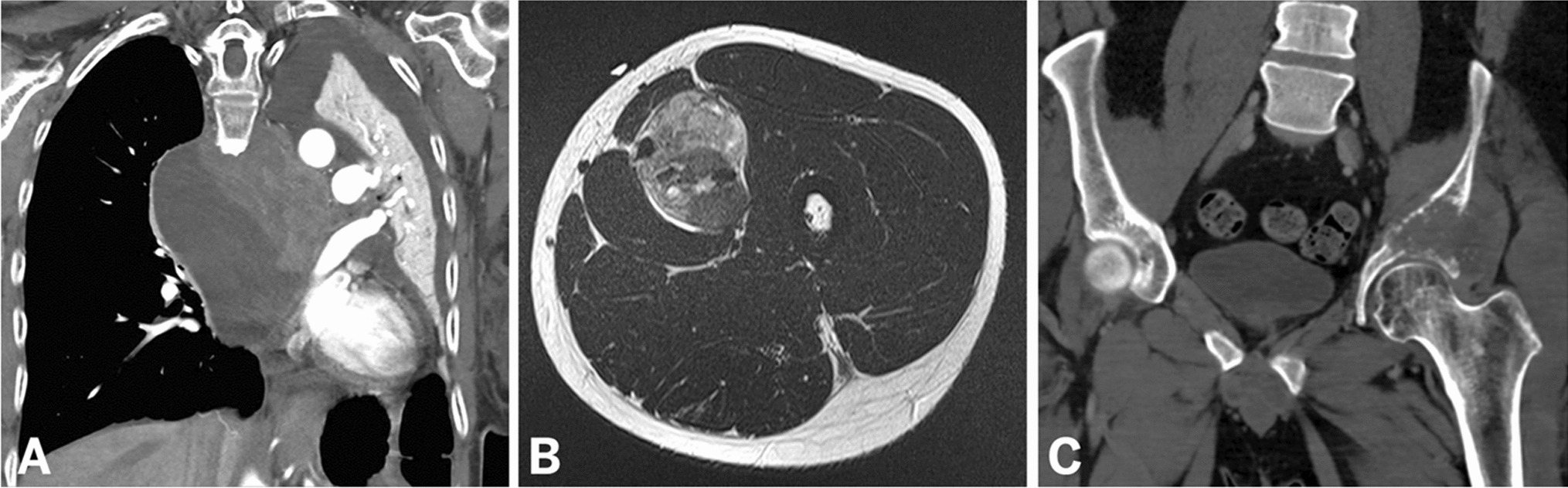 YAP1::KMT2A-rearranged sarcomas harbor a unique methylation profile and are distinct from sclerosing epithelioid fibrosarcoma and low-grade fibromyxoid sarcoma