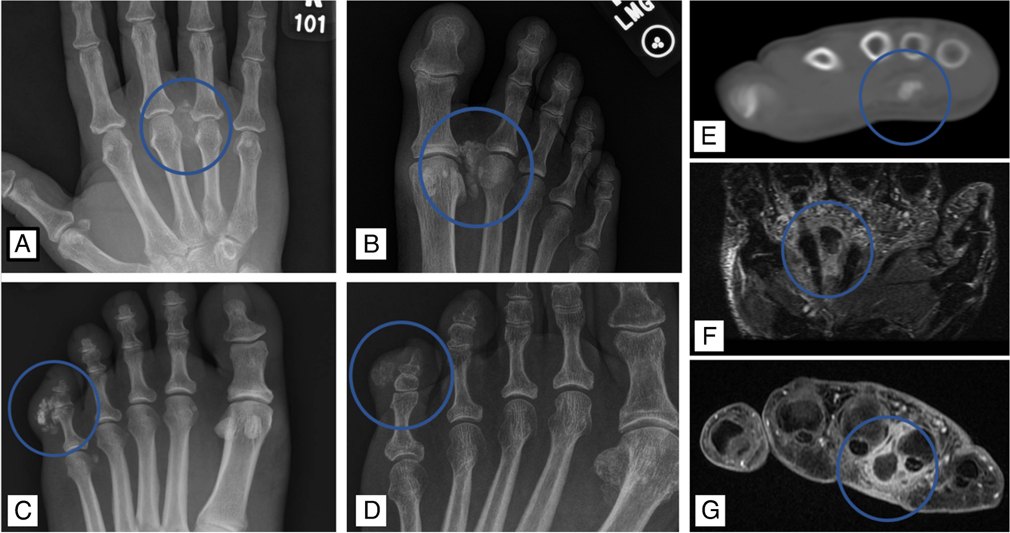 Tenosynovitis with psammomatous calcifications: Series of 18 cases and review of the literature emphasizing a common source of expert consultation and updated differential diagnosis