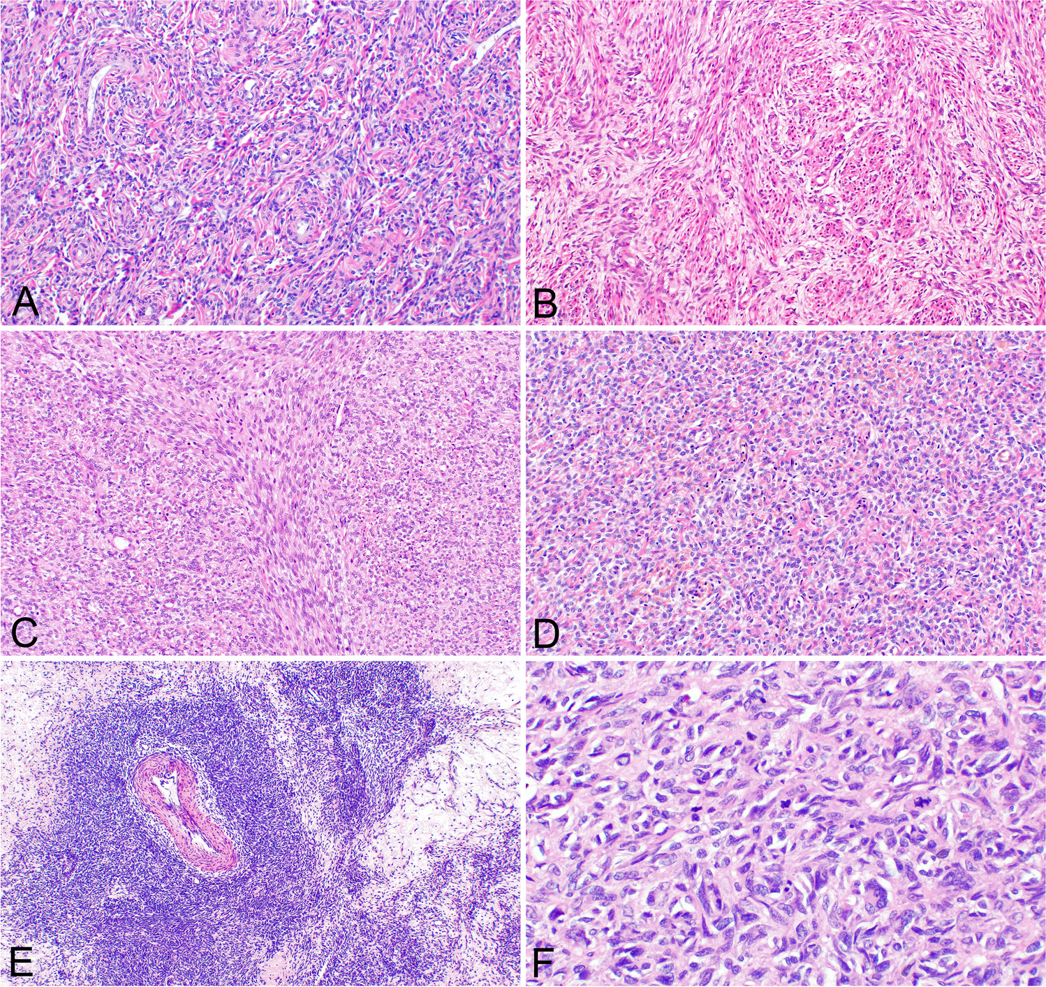 Uterine sarcoma with KAT6B/A::KANSL1 fusion: a molecular and clinicopathological study on 9 cases