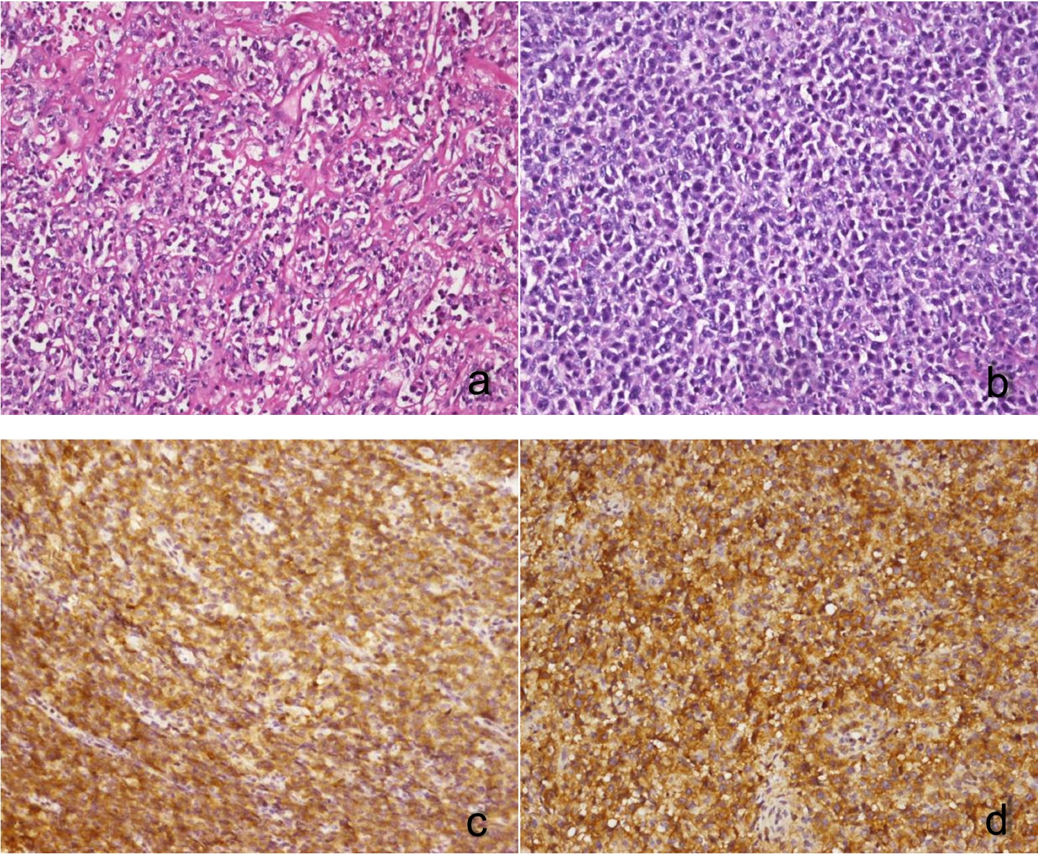 High expression of RHOF is an effective diagnostic marker and a potential prognostic indicator for primary mediastinal large B-cell lymphoma