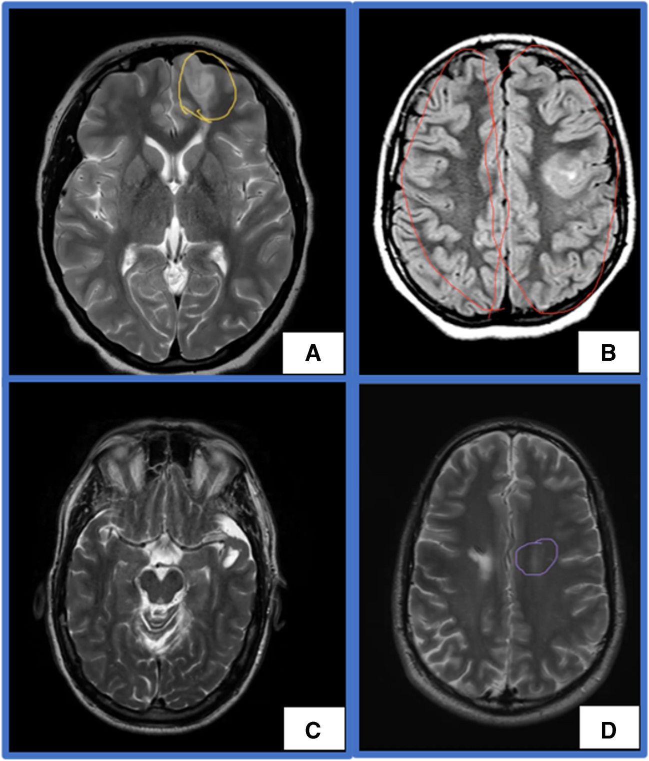Visual Art-Based Training Improves Medical Students’ Radiologic Labeling Skills by Improving Their Contrast Sensitivity: A Prospective, Controlled Study