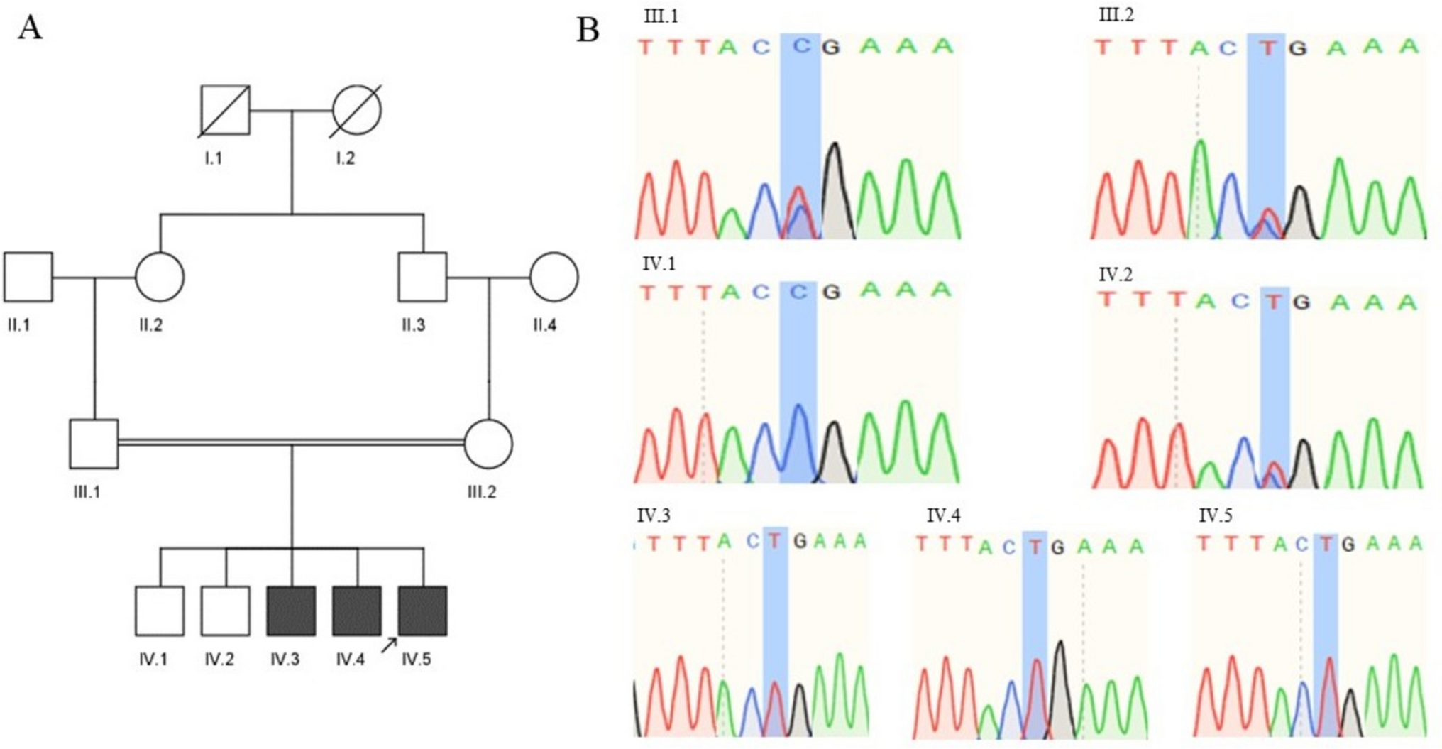 A Novel Pathogenic Mutation in WNK1 Gene Causing HSAN Type II in Three Siblings