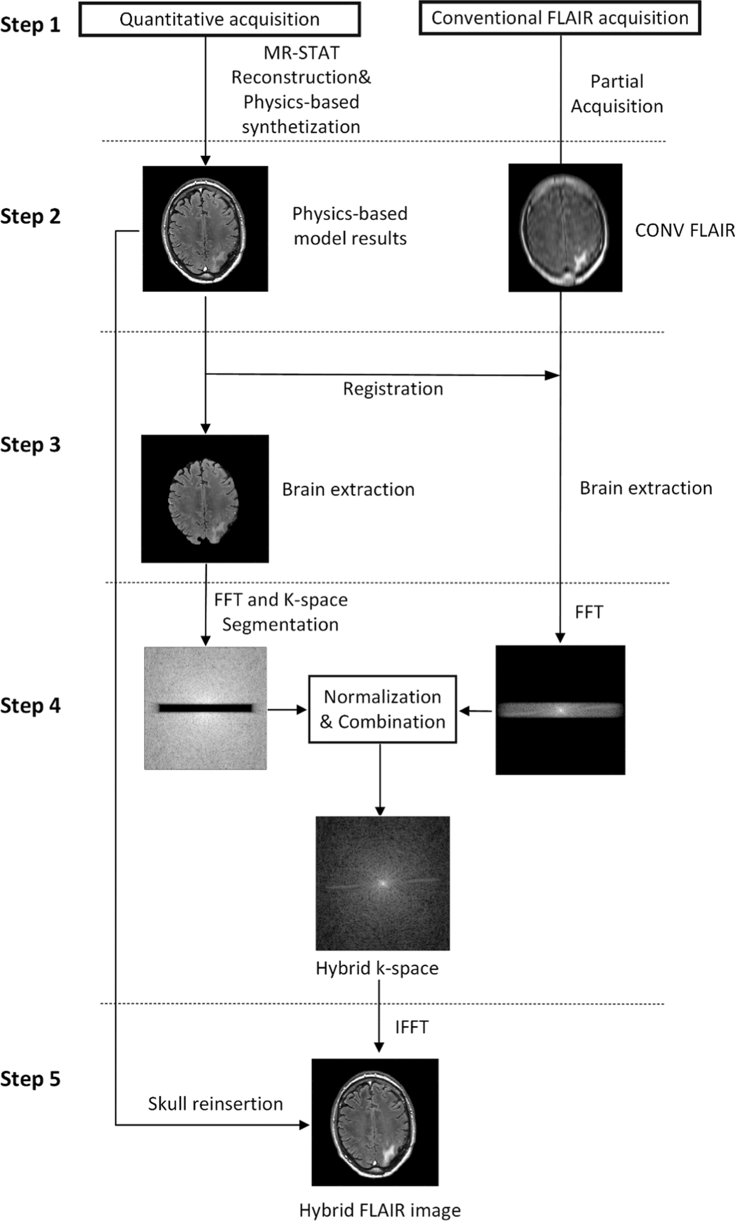 Improving the lesion appearance on FLAIR images synthetized from quantitative MRI: a fast, hybrid approach