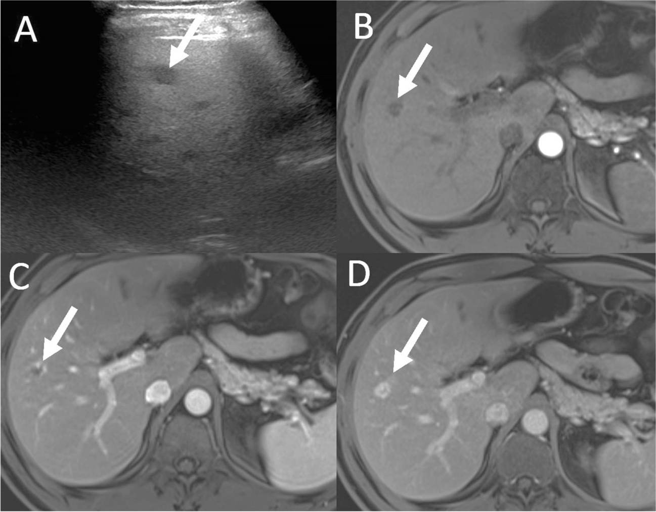 Unusual appearance of hepatic cavernous hemangioma on ultrasound in a patient with fatty liver