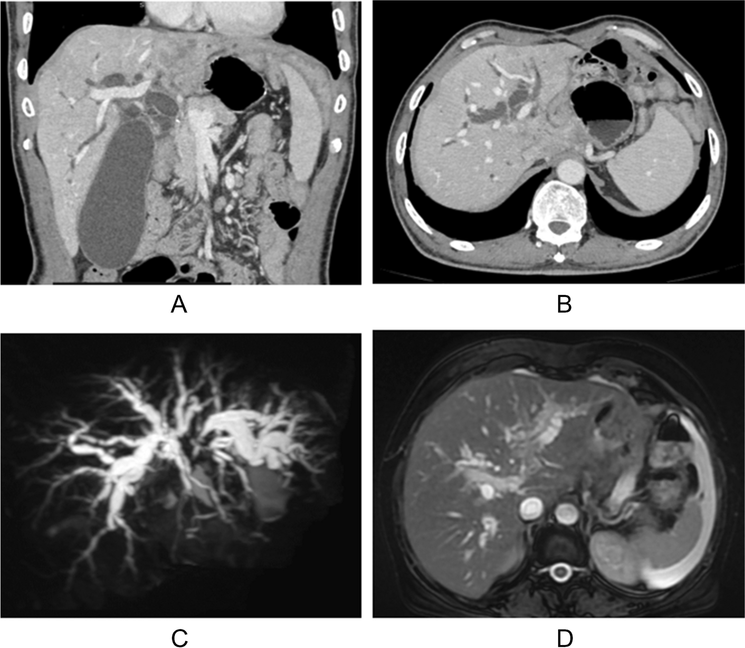 EUS-guided biliary drainage in patients with malignant biliary obstruction with total gastrectomy status: Jejunum to rescue