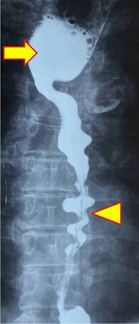 Corkscrew esophagus due to type-3 achalasia: A rare combination