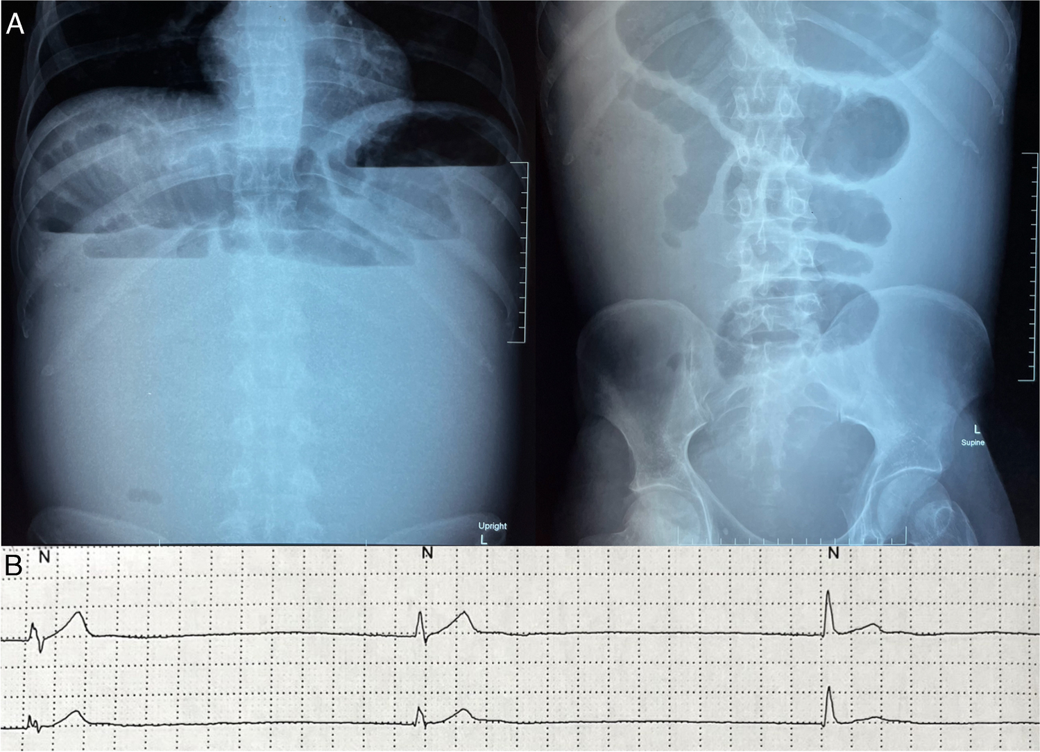 When gut meets the heart: Chronic atrial and intestinal dysrhythmia presenting as chronic intestinal pseudo-obstruction, an uncommon cohesinopathy