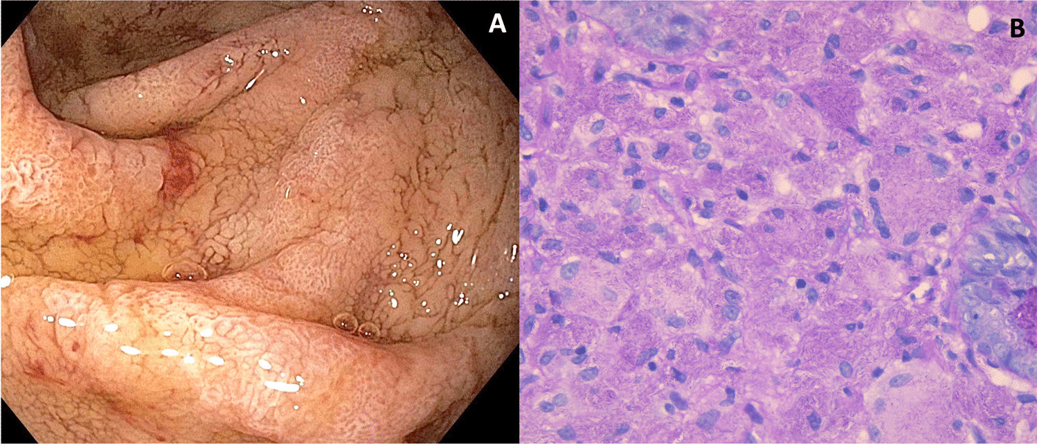 Mycobacterium avium complex small bowel disease mimicking Whipple’s disease