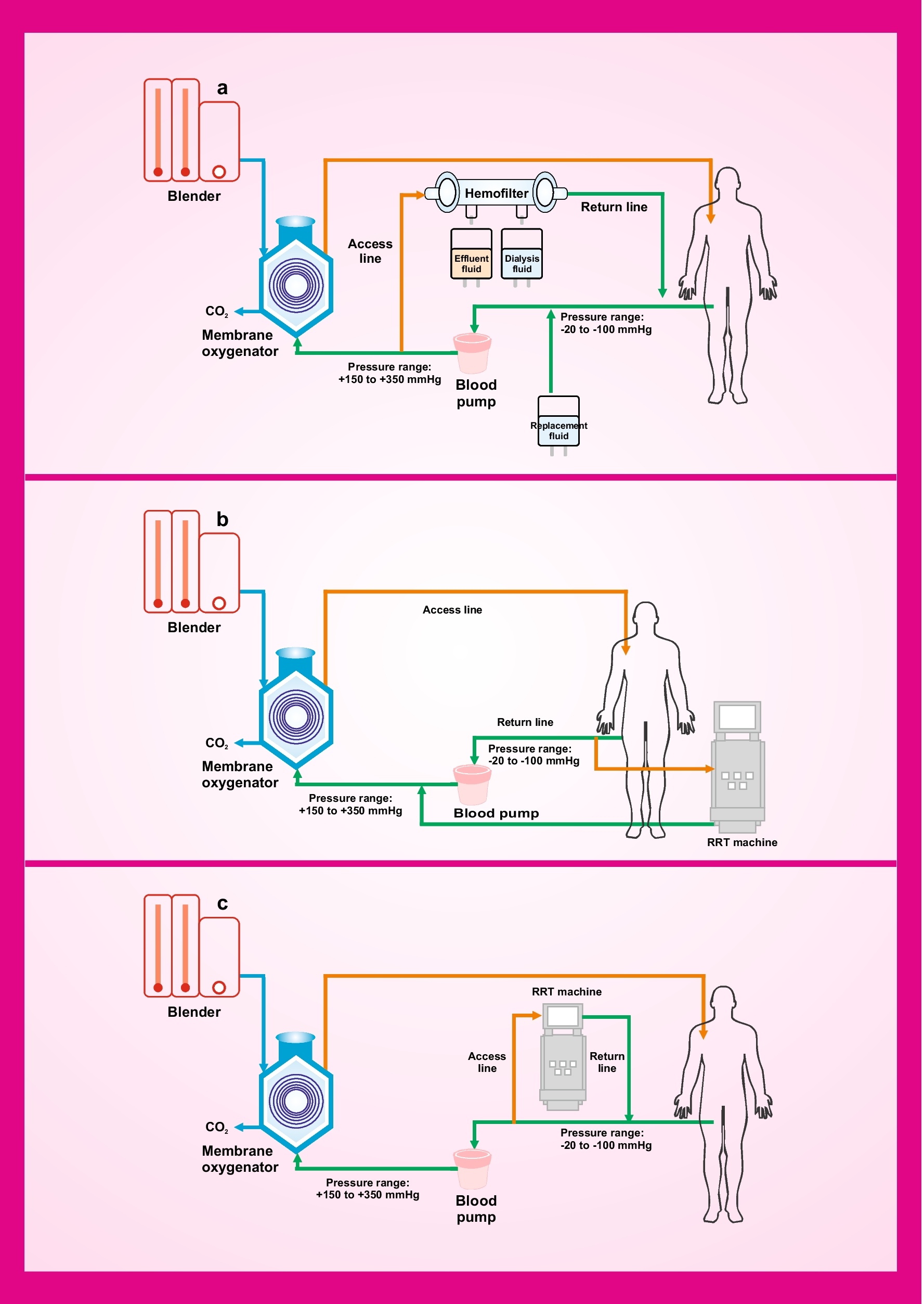 Concurrent use of continuous kidney replacement therapy during extracorporeal membrane oxygenation: what pediatric nephrologists need to know—PCRRT-ICONIC practice points
