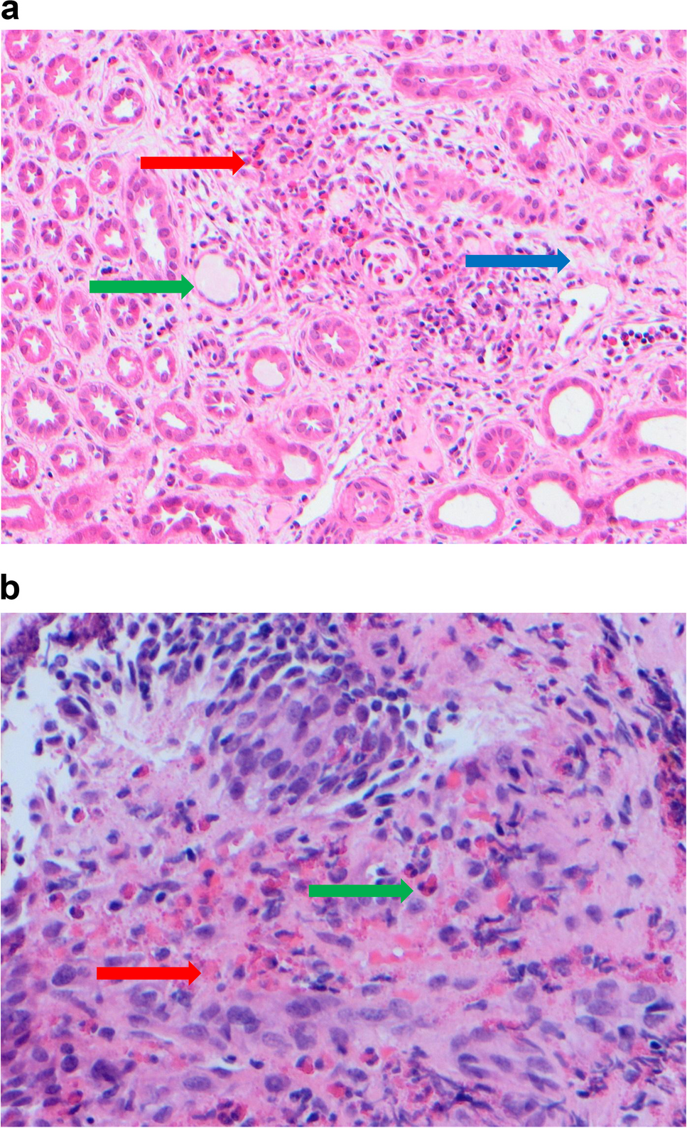 Eosinophilic cystitis—an obscure case of obstructive uropathy in infancy