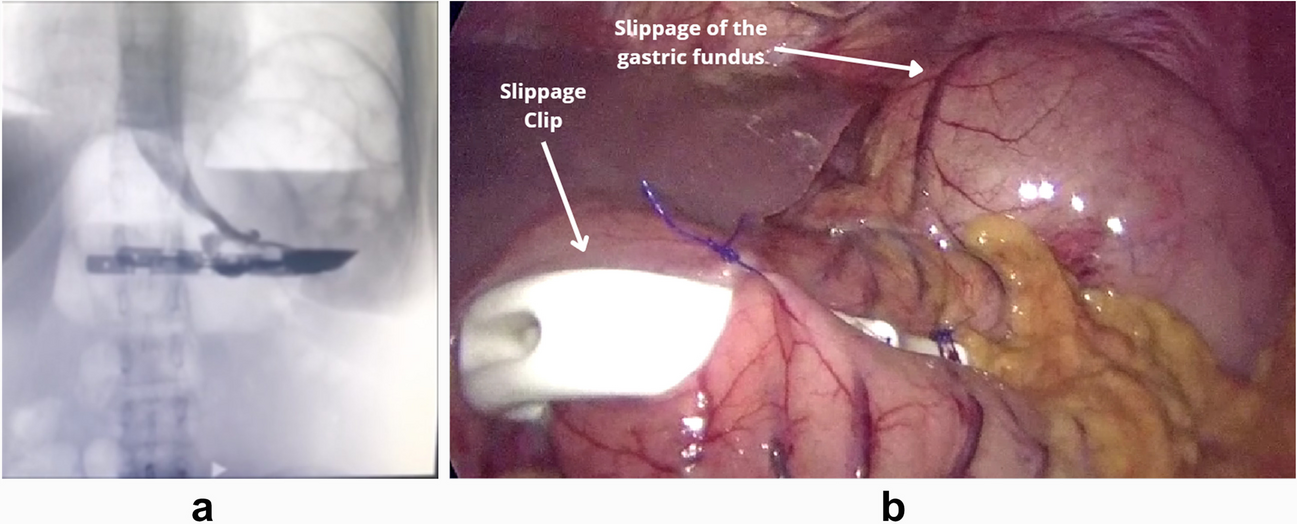 Laparoscopic Vertical Clip Gastroplasty with BariClip Experience, Complications, Literature Review, and Proposal of Modification of the Original Technique