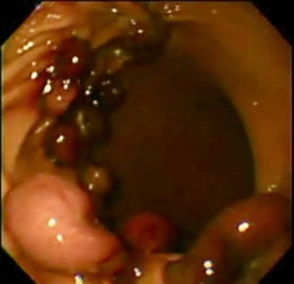 Endoscopic Band Ligation for Weight Loss: A Clinical Trial