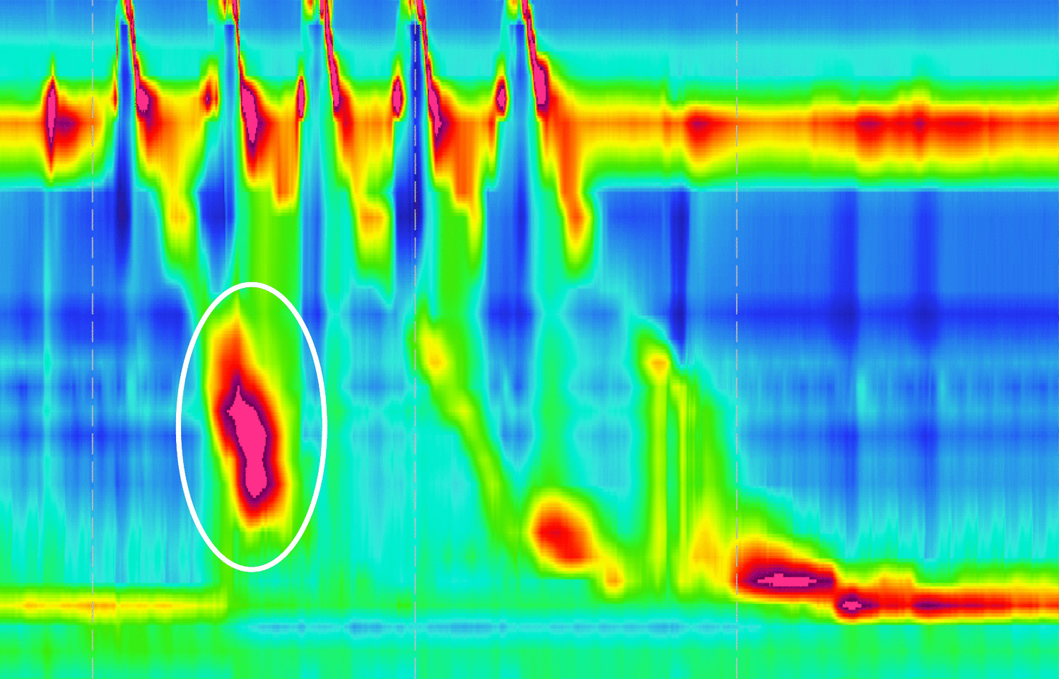 Breakthrough Contractions During Multiple Rapid Swallows on High-Resolution Esophageal Manometry: A Marker of Esophageal Dysmotility in Post-Bariatric Surgery Patients