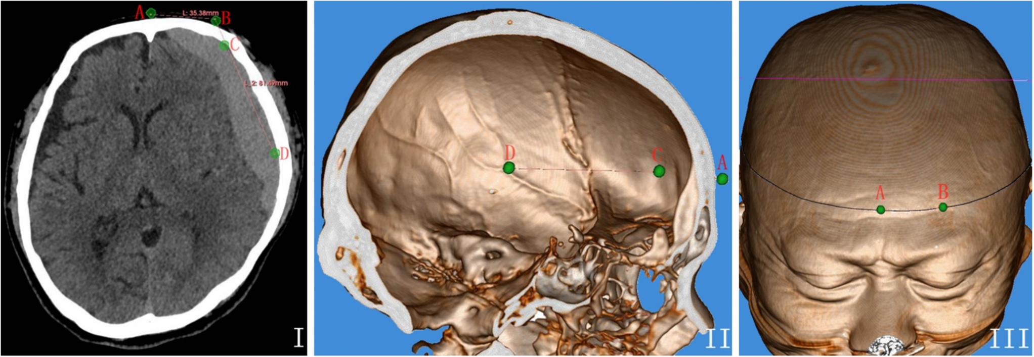 Efficacy of minimally invasive soft-channel drainage for chronic subdural hematoma utilizing 3D slicer: a retrospective comparative analysis