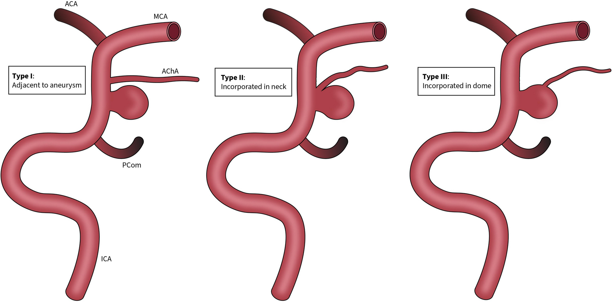 Anterior choroidal artery aneurysm case series: a clinical decision algorithm for endovascular and surgical treatment using a novel classification system