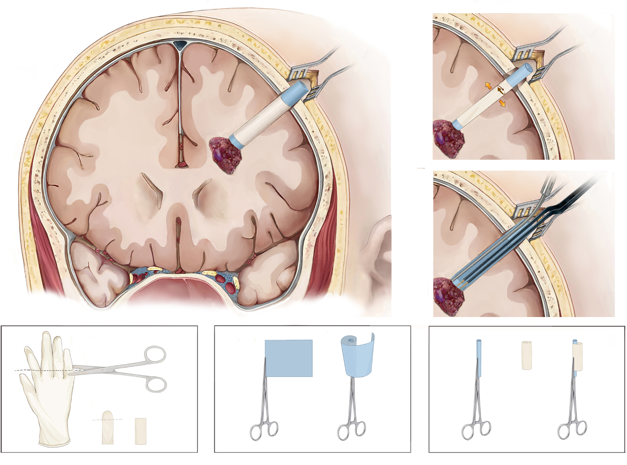 Minimally invasive neurosurgery: application of burr-hole technique across a spectrum of brain lesions