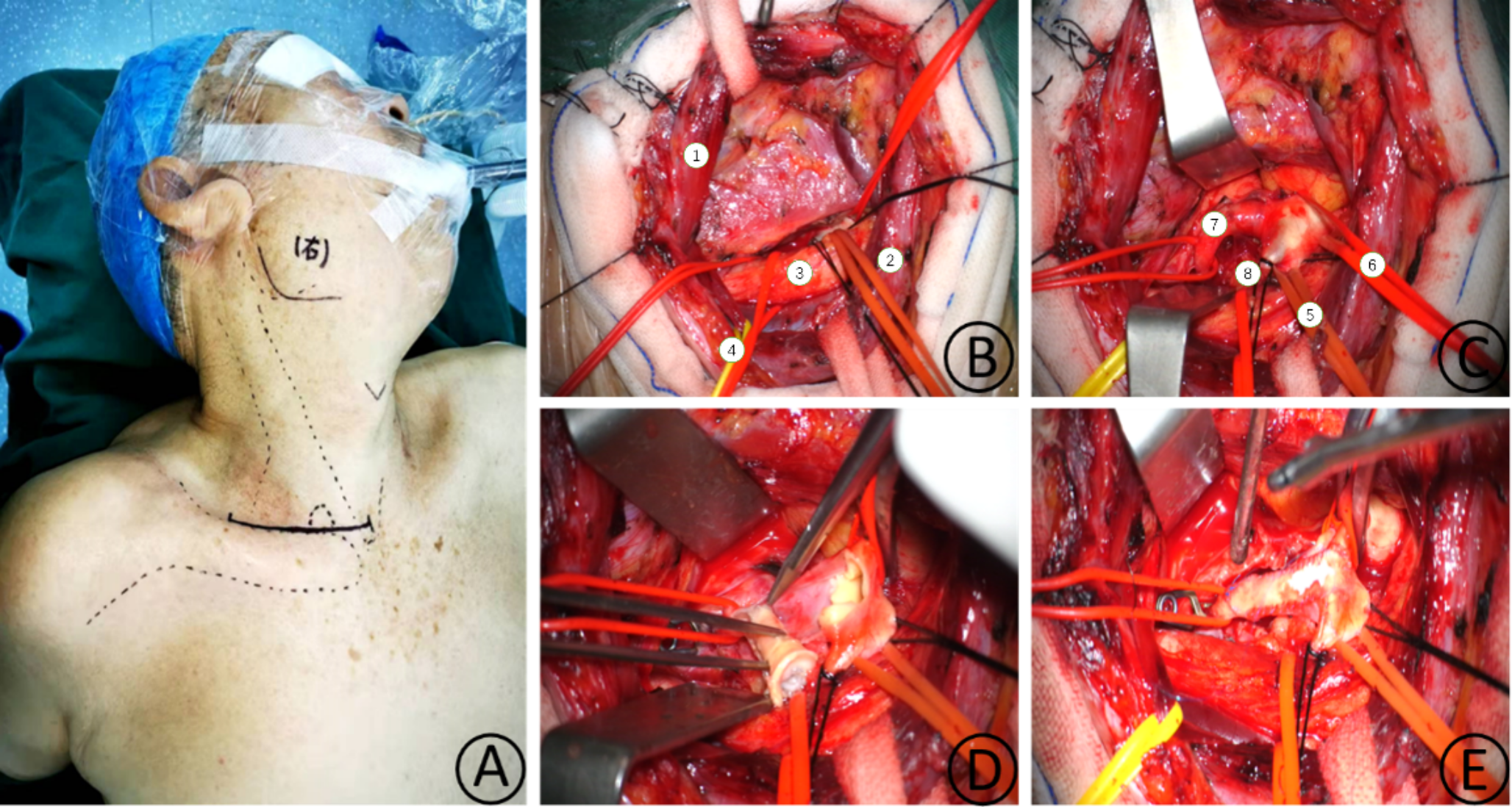 Application of microsurgical surgery in patients with proximal vertebral artery stenosis unsuited for endovascular treatment: a single-center retrospective study