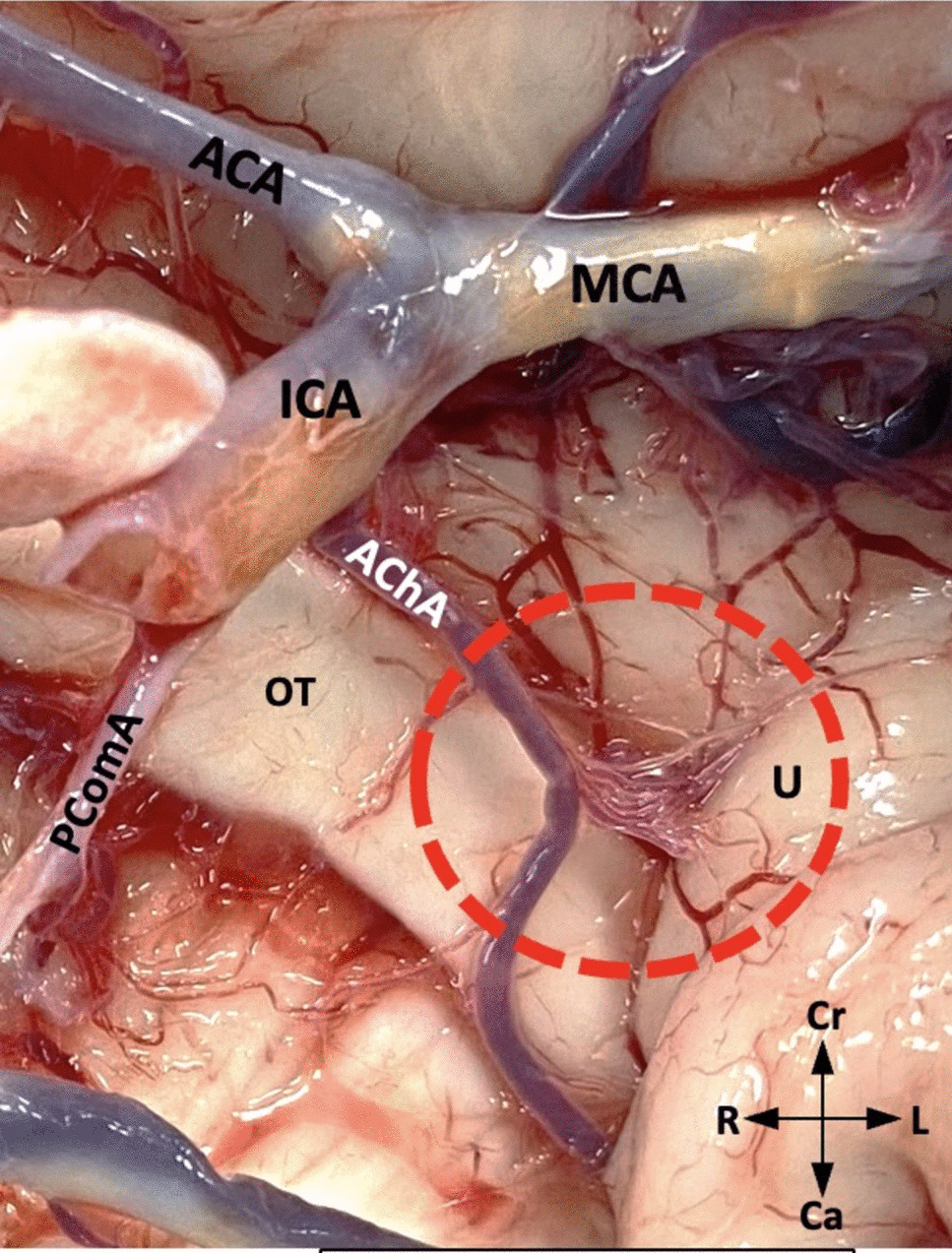 Distribution of branches of anterior choroidal artery in the uncus: an anatomical study