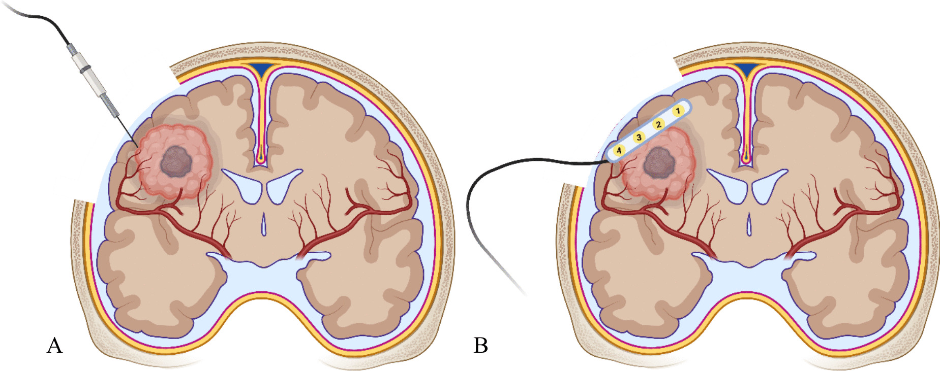 Surgical identification of brain tumour margins through impedance monitoring and electrocorticography and the potential for their combined use: A systematic review