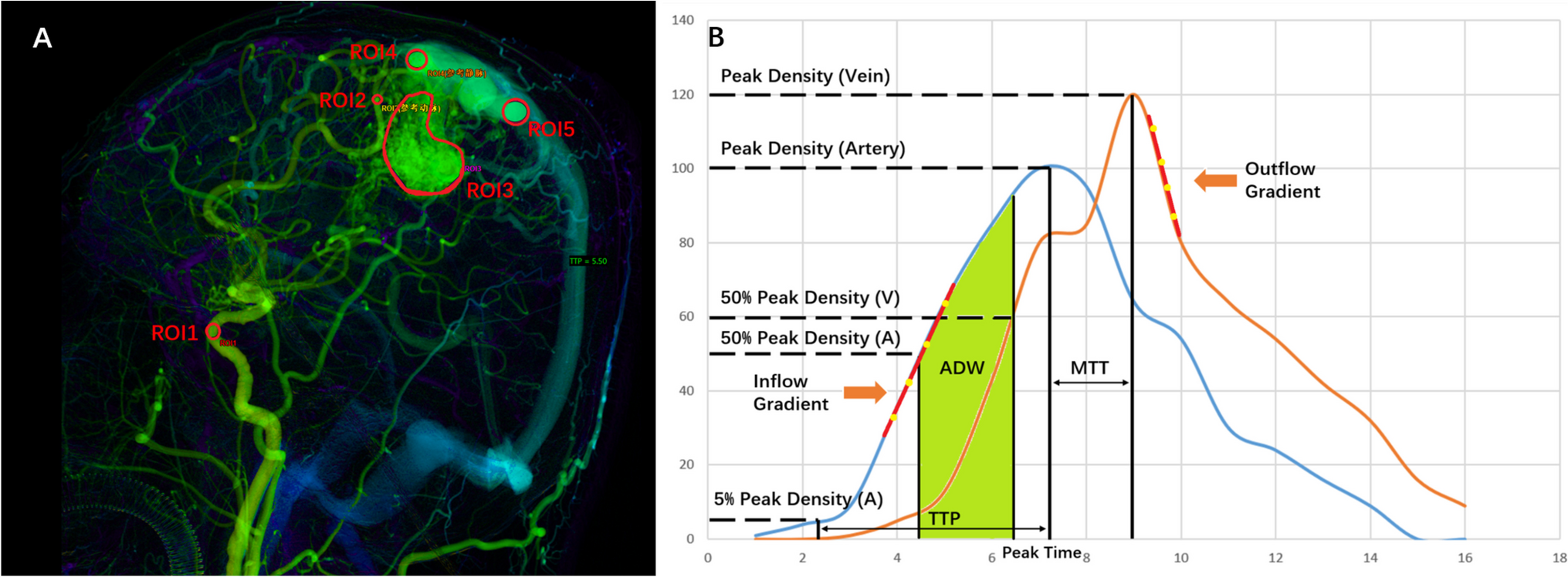 Lesion filling index predicts brain arteriovenous malformation obliteration after Gamma knife radiosurgery: a hemodynamic analysis