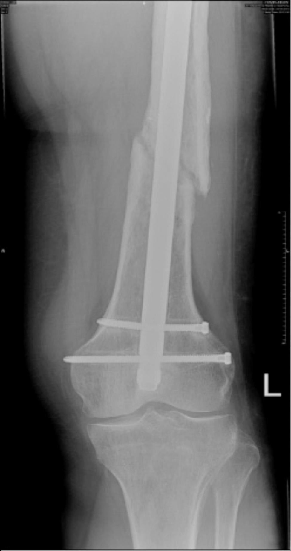 Role of vascularised fibula graft in the surgical management of radiation-induced midshaft femoral fractures. Case report and literature review