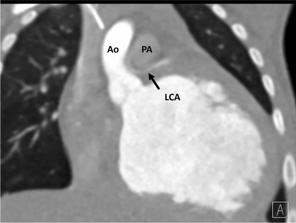 Imaging of common coronary artery anomalies and imaging features important for clinical decision-making