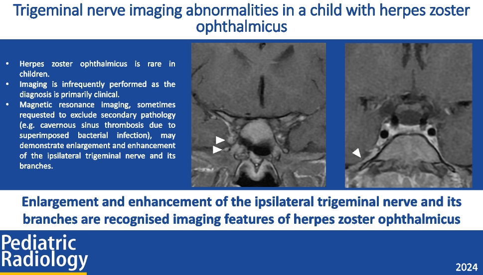 Trigeminal nerve imaging abnormalities in a child with herpes zoster ophthalmicus