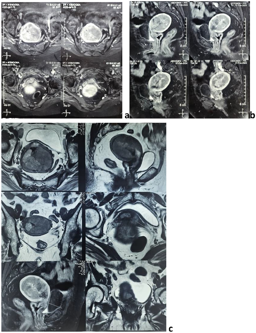 Pelvic Collision Tumor: An Intersection of Two Malignancies