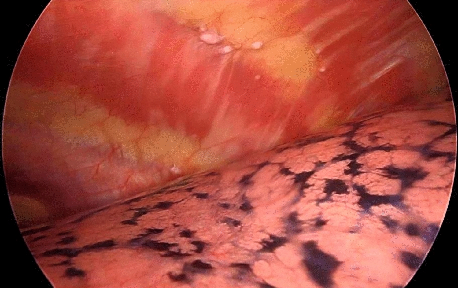 Heated Intra-Thoracoabdominal Cavity Chemotherapy (HITAC): A Novel Technique in Advanced Carcinoma Ovary