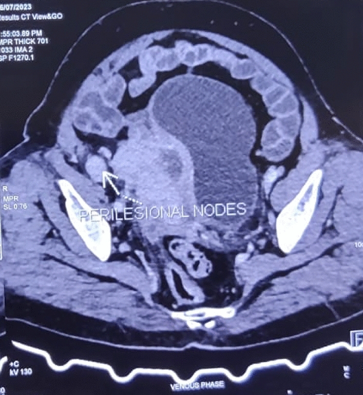Pelvic Actinomycosis Mimicking as an Ovarian Mass: A Case Series