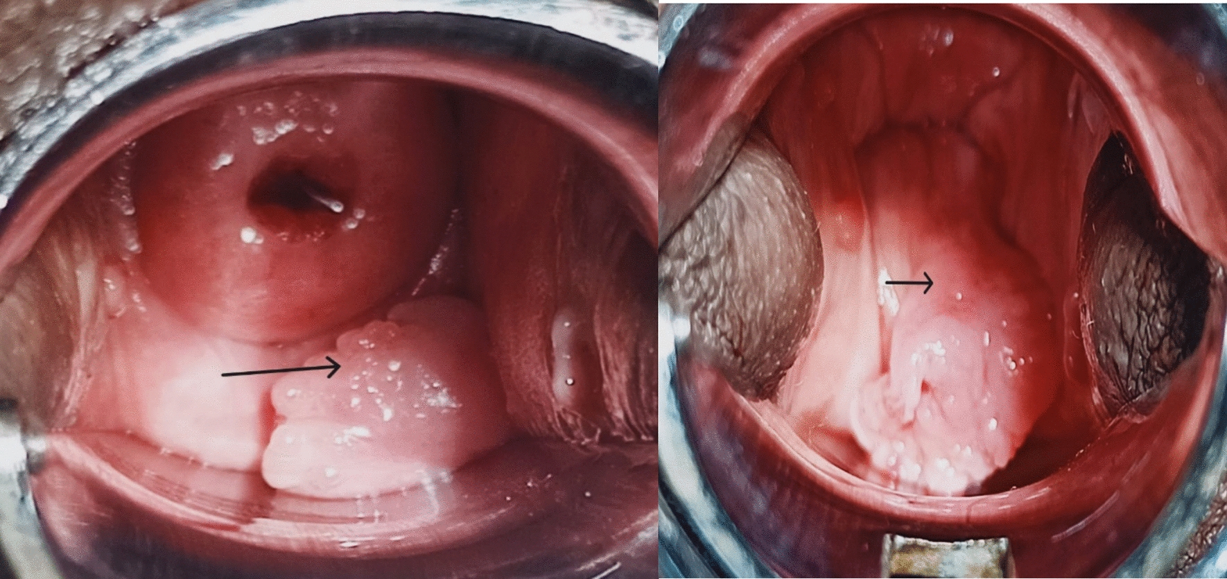 Cellular Angiofibroma of Vagina: A Rare Tumor with Unique Pathology