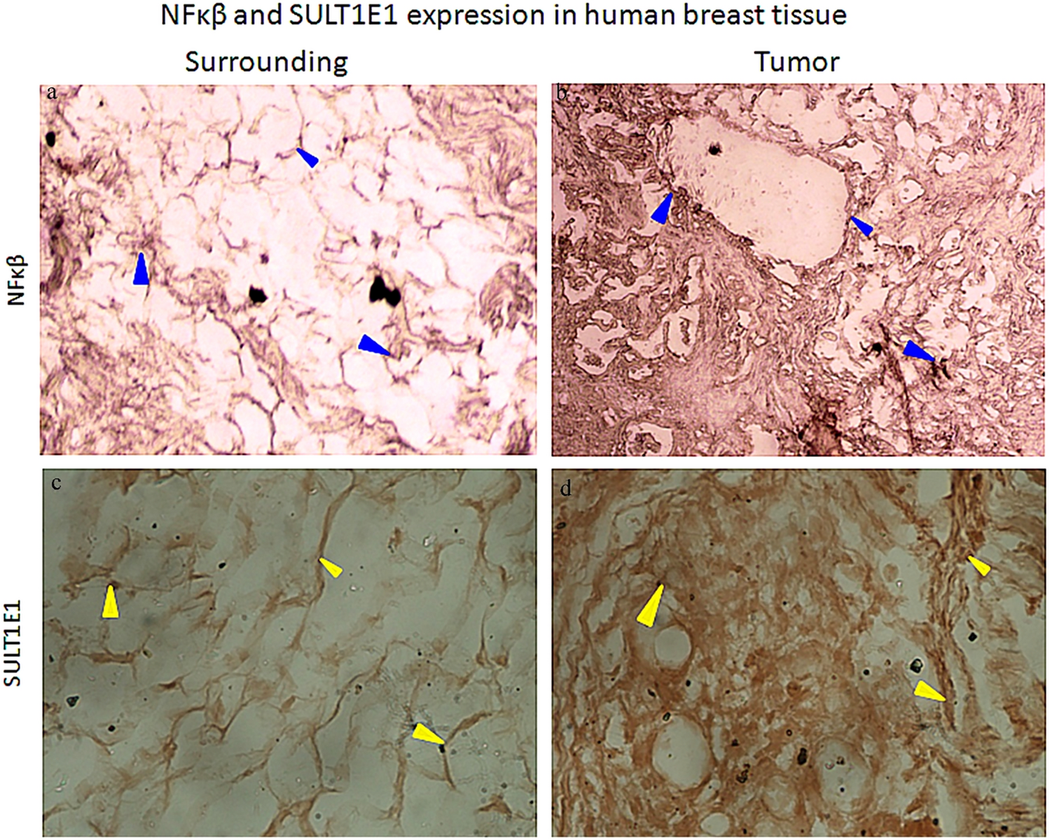 Estrogen Sulfotransferase (SULT1E1) and NFκβ Confer Matrix Metalloprotease (MMP 2/9) Action in Breast Carcinogenesis