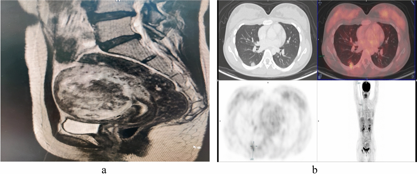 From Crisis to Conception: An Unusual Case of PSTT with Fertility Rescue