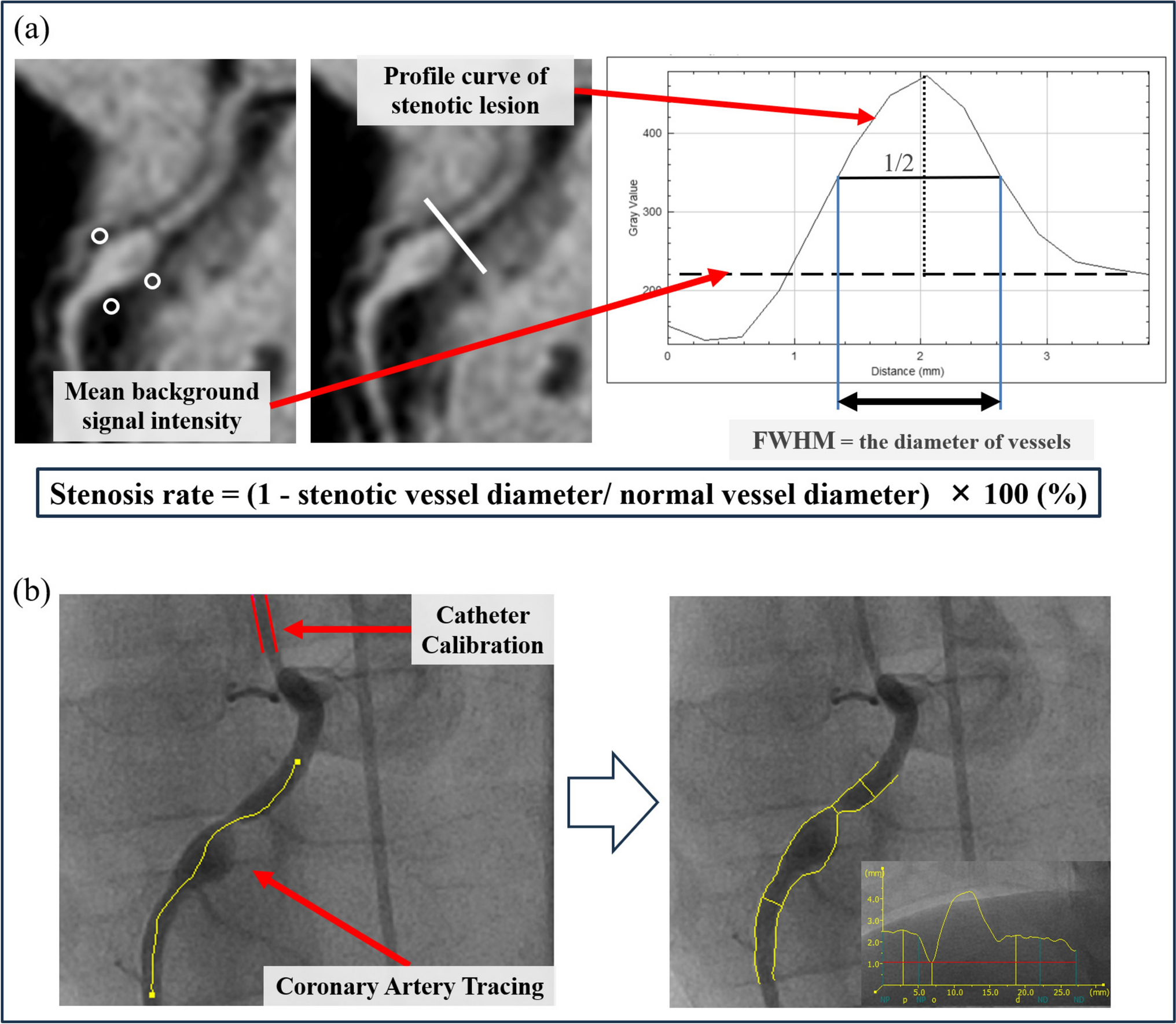 Long-Term Coronary Artery Evaluation Using Noncontrast-Enhanced Magnetic Resonance Angiography in Patients with Kawasaki Disease