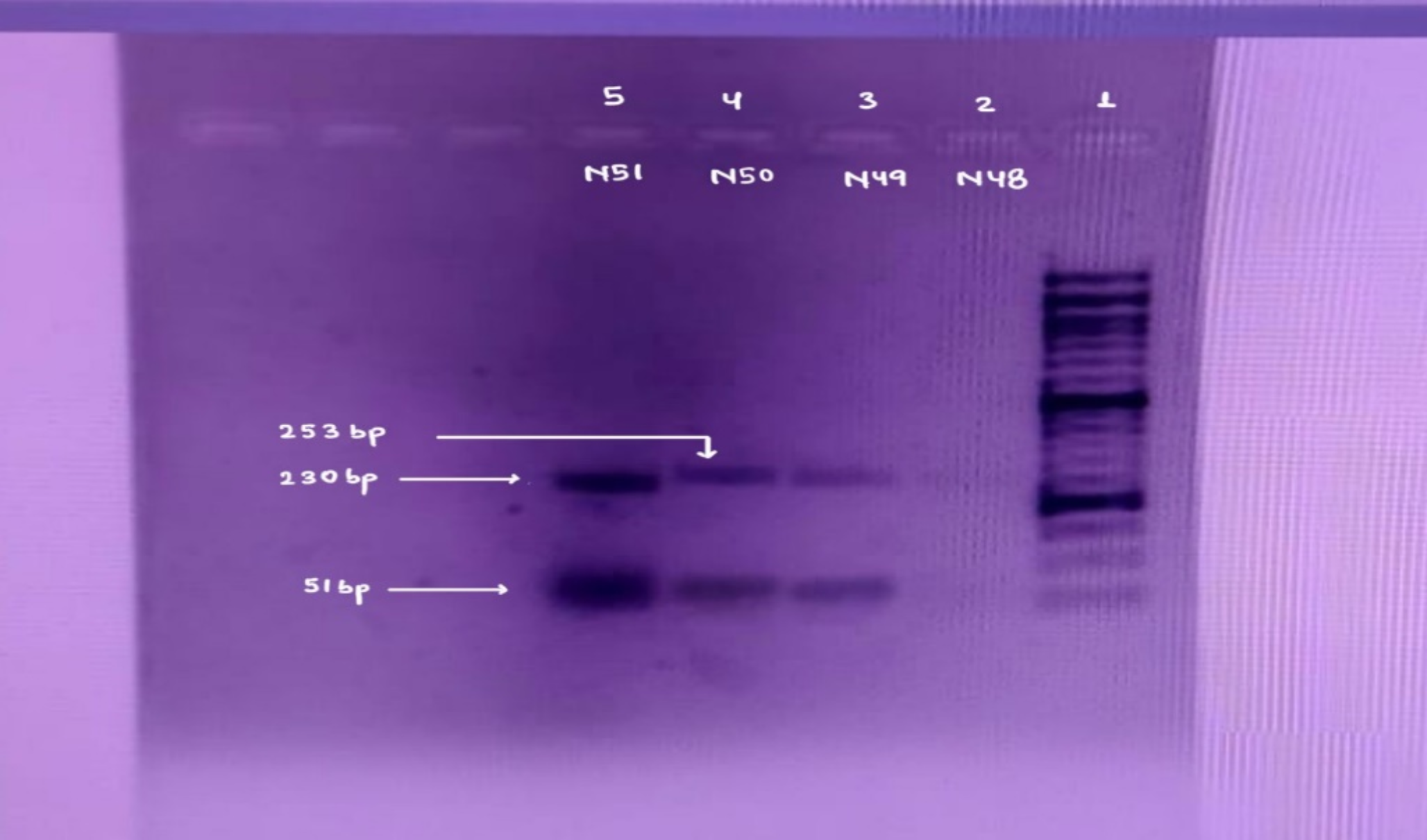 Tissue Inhibitor of Metalloproteinase 2 (TIMP 2) Promotor 418 G > C Polymorphism in Non-alcoholic Fatty Liver Disease (NAFLD) Patients of Eastern States of India